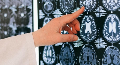Cleveland Clinic hace un llamado a no ignorar cualquier síntoma neurológico inusual
