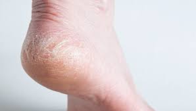 ¿Cómo prevenir un esguince de tobillo?