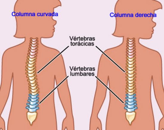 Si la columna vertebral de tu hijo parece estar curvada