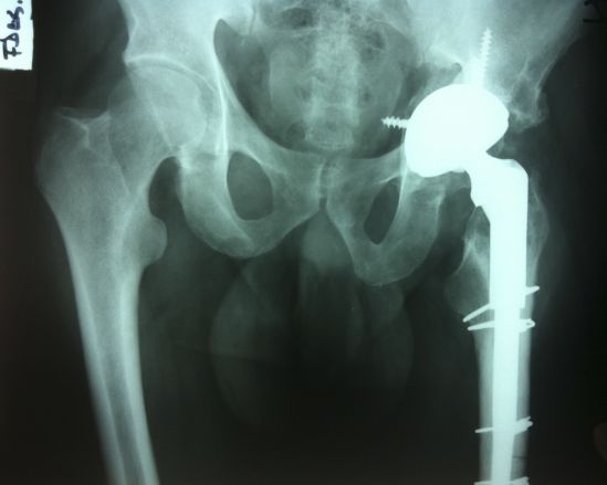 Después de una artroplastia de cadera, las piernas pueden tener diferente longitud