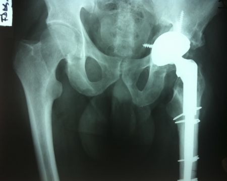 Después de una artroplastia de cadera, las piernas pueden tener diferente longitud
