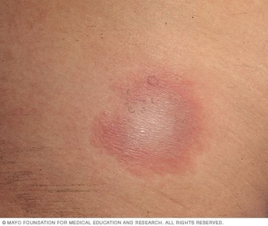 Enfermedad de Lyme