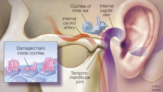 Los implantes cocleares, alternativa ante pérdida auditiva avanzada