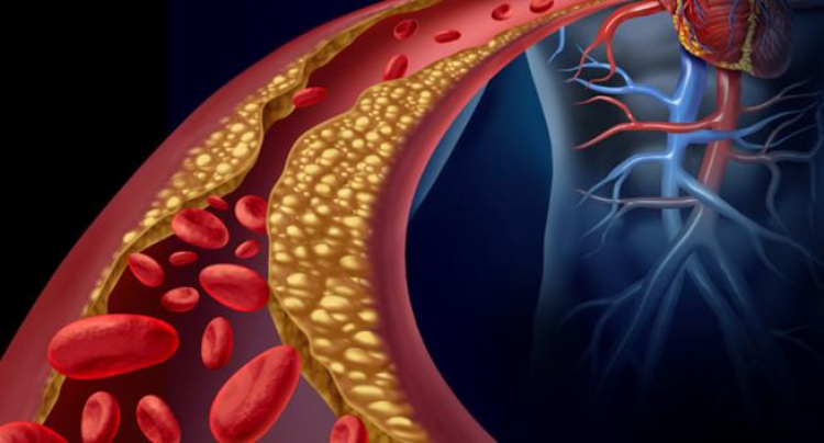 Opinión :: Lo que no se sabía de la hipercolesterolemia