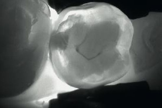 Técnica por fibra óptica digital permite detectar el 90% de la caries que no son visibles