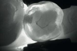 Técnica por fibra óptica digital permite detectar el 90% de la caries que no son visibles