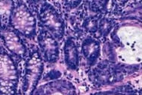 Cáncer metastásico principal causa de muerte en mujeres en México