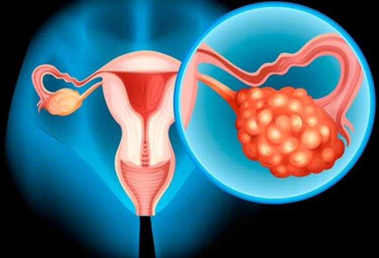 Cáncer de ovario: una batalla para las mujeres