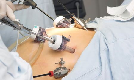 Cirugía bariátrica brinda control a largo plazo en pacientes con obesidad y diabetes T2, según estudio
