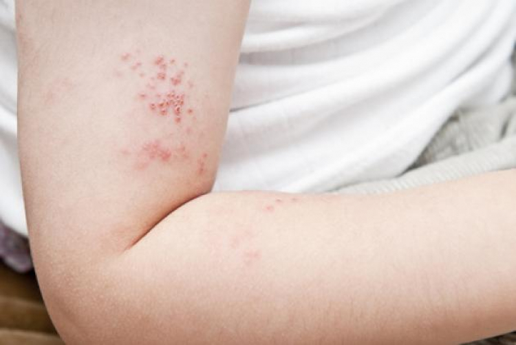 Alrededor del 5% de los adultos con dermatitis atópica en México presentan una enfermedad grave no controlada