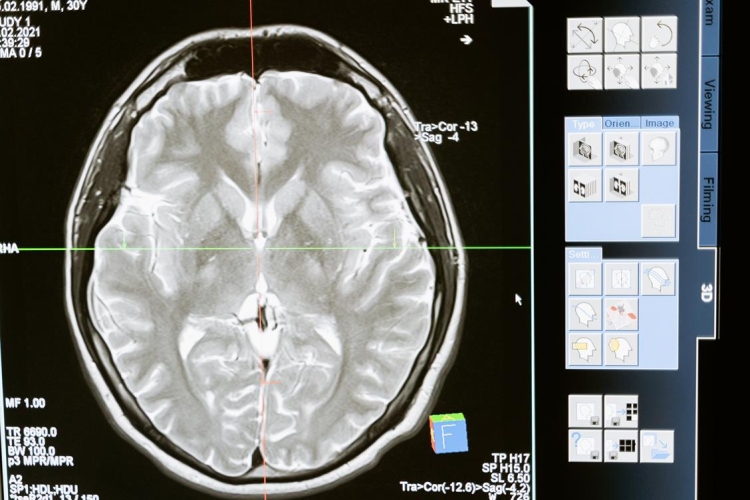 Investigadores de Mayo Clinic logran hallazgos clínicos sobre enfermedad relacionada a la demencia que podrían evitar al paciente llegar a tenerla