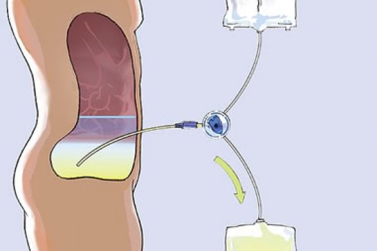 Telemonitoreo aplicado en nuevo dispositivo para diálisis peritoneal, disponible en México