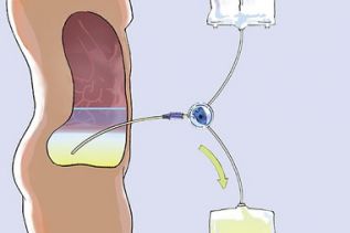 Telemonitoreo aplicado en nuevo dispositivo para diálisis peritoneal, disponible en México