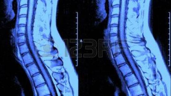 Cómo detectar y tratar una hernia discal
