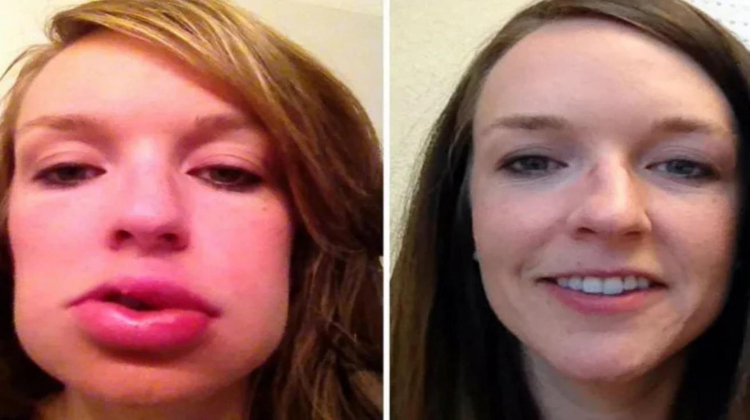 Takeda México lanza nueva terapia para pacientes con angioedema hereditario