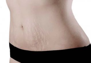 Marcas en la piel y en las emociones