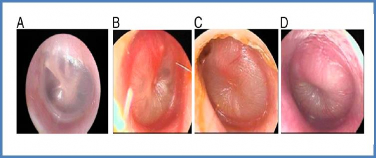 El 80% de los niños sufre al menos un episodio de otitis media antes de los 6 años