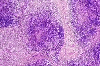 Linfoma: la precisión en el diagnóstico aumenta las posibilidades de un tratamiento eficaz
