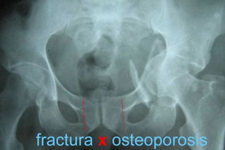 “No más fracturas”, campaña digital en apoyo a pacientes con osteoporosis