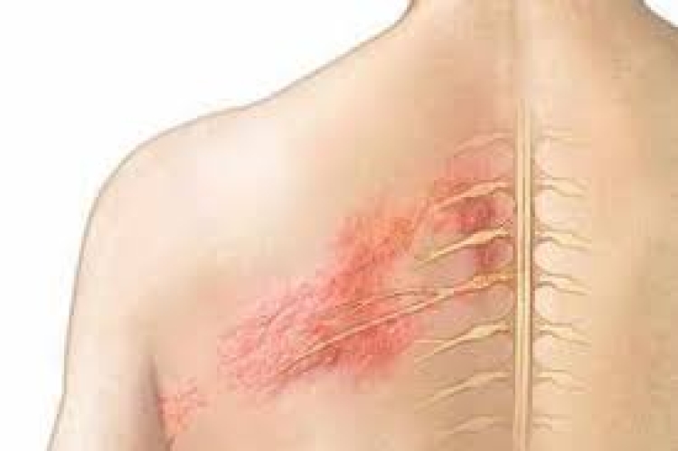Herpes zóster, un motivo para olvidar diferencias y enviar un mensaje de prevención para adultos +50 años