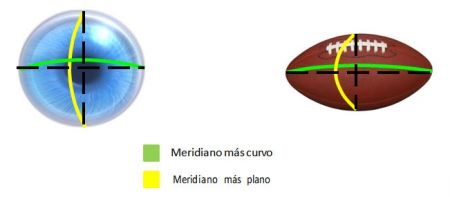 ¿Qué hacer con astigmatismo alto?