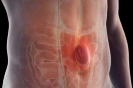 Hernias abdominales llegan a afectar entre el 10 al 15% de la población