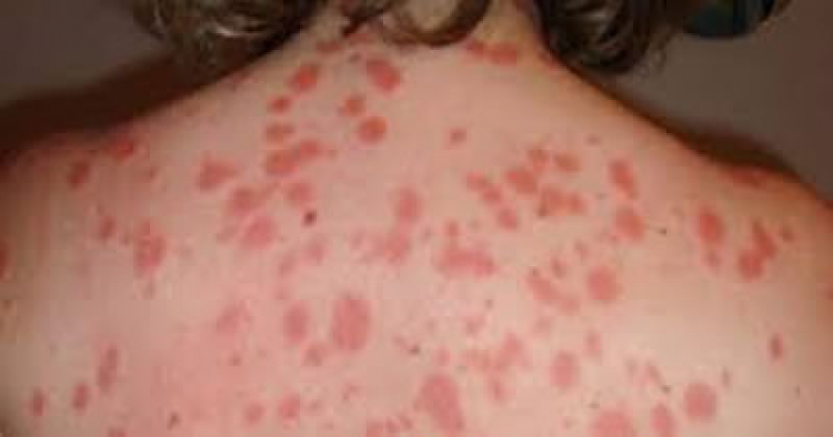 Psoriasis, impacta la calidad de vida del paciente