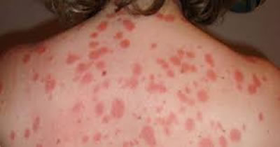 Psoriasis, impacta la calidad de vida del paciente