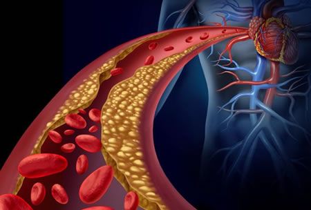 Estudio de Mayo Clinic vincula células senescentes con avance de ateroesclerosis