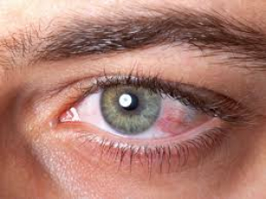 ¿Qué hay que saber sobre la conjuntivitis?