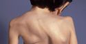 Síndrome de Morquio: enfermedad huérfana difícil de diagnosticar
