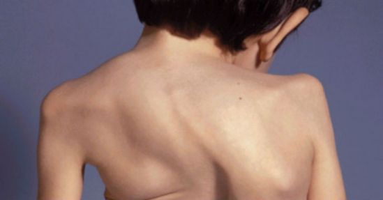 Síndrome de Morquio: enfermedad huérfana difícil de diagnosticar