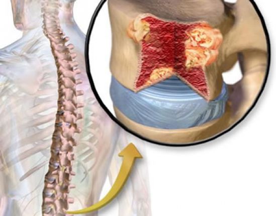 Aprueban FDA y COFEPRIS Denosumab para la prevención de eventos relacionados con el sistema óseo en pacientes con mieloma múltiple