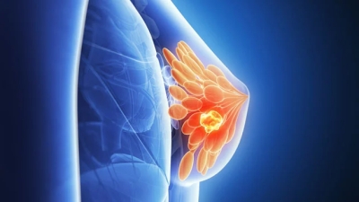 Innovación en acción: aplicaciones subcutáneas de 8 min que redefinen la atención del cáncer de mama