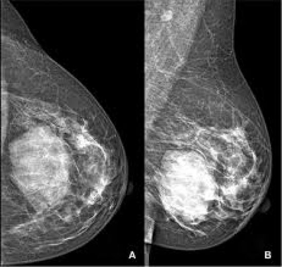 Tres razones para la mamografía tridimensional