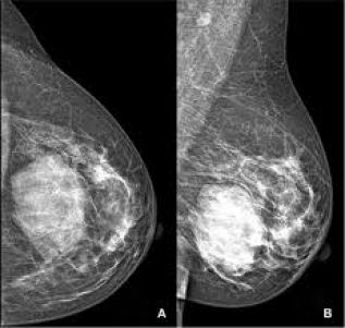 Tres razones para la mamografía tridimensional