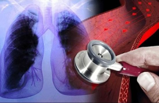 Especialistas llaman a priorizar diagnóstico y tratamiento de Hipertensión Arterial Pulmonar