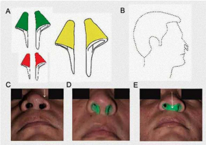 Mejoran simetría del ala nasal en pacientes con labio y paladar hendido
