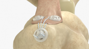 Profesor del Tec de Monterrey crea cinchos quirúrgicos para reparar tendones y ligamentos