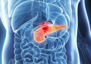 Inmuno-oncología: la nueva apuesta de la medicina para pacientes con cáncer metastásico