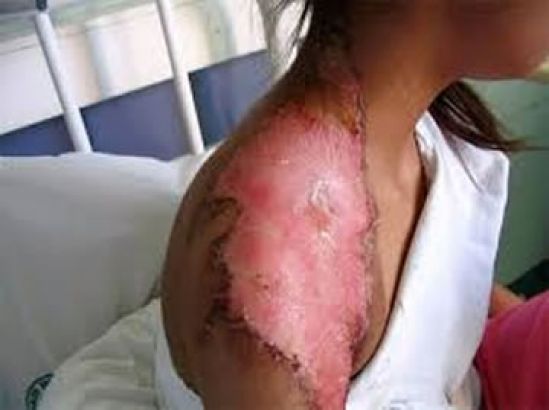 Cinvestav obtiene biomaterial para evitar infecciones durante el tratamiento por quemaduras