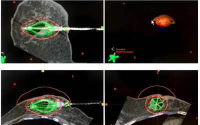 Braquiterapia y cirugía estereotáctica, innovación en la lucha contra el cáncer de mama