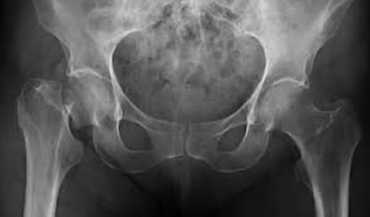 El análisis de microbiota intestinal se perfila como marcador de diagnóstico de osteoporosis
