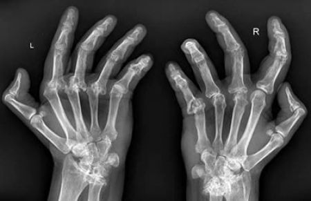 Pacientes con artritis reumatoide en AL, conocen poco sobre medicamentos biotecnológicos para tratar este padecimiento 