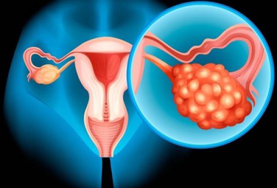 INCan y AMLCC buscan impulsar el diagnóstico y tratamiento oportuno de cáncer de ovario