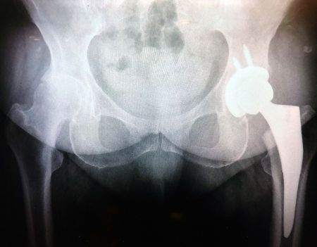 Especialistas realizan cirugías óseas de mínima invasión