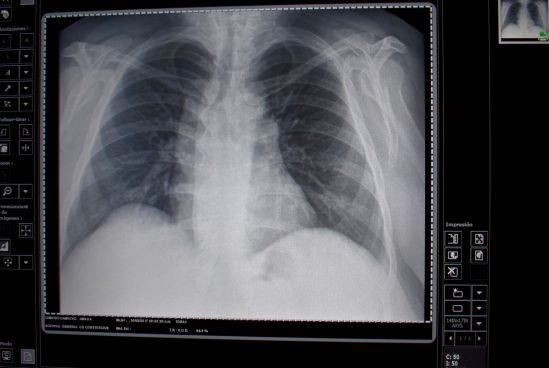 Ultrasonido, clave en la prevención de enfermedad pulmonar intersticial