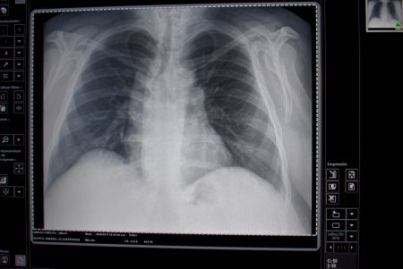 Ultrasonido, clave en la prevención de enfermedad pulmonar intersticial