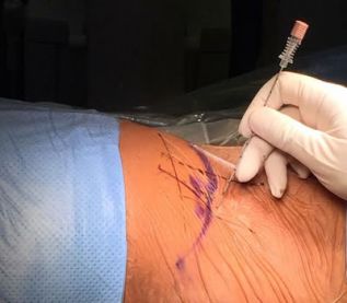 Llega a México nueva técnica de endoscopia de míninma invasión, optimiza cirugías de hernias de disco