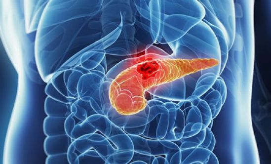 Investigadores de Mayo Clinic identifican método para diagnosticar cáncer de páncreas en pacientes con diabetes incipiente